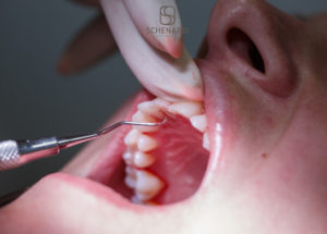 terapia causale parodontale | Studio Dentistico Schenardi