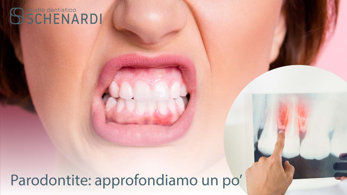 parodontite img cop